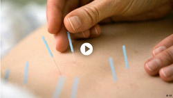 Akupunktur - geheimnisvolle Nadeln - Videobeitrag
